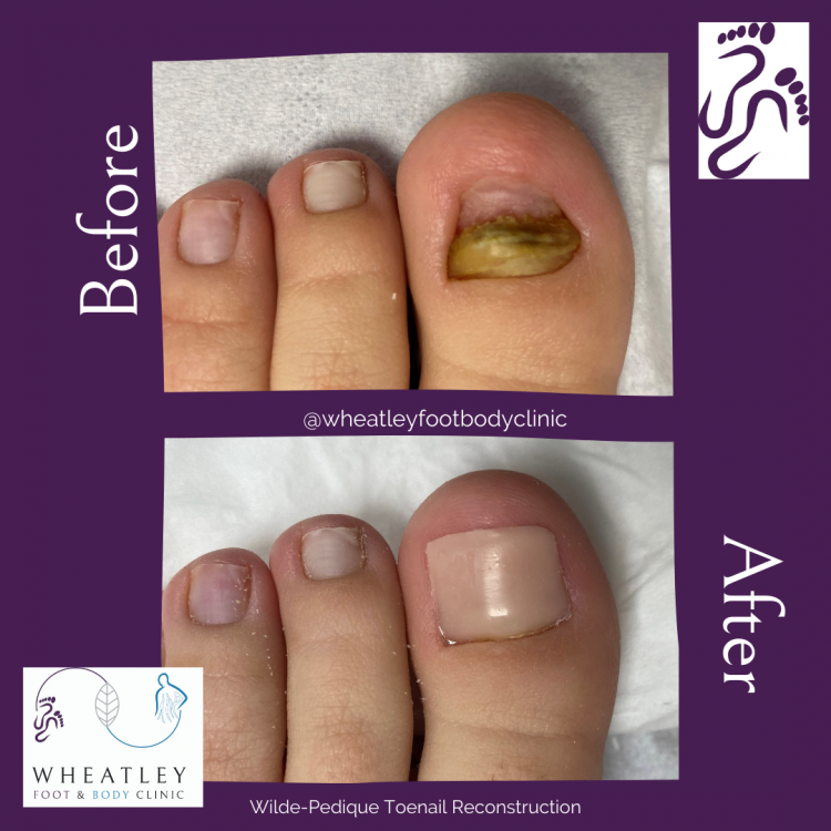 Toenail Reconstruction