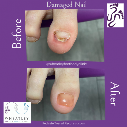 Toenail Reconstruction