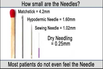 needling