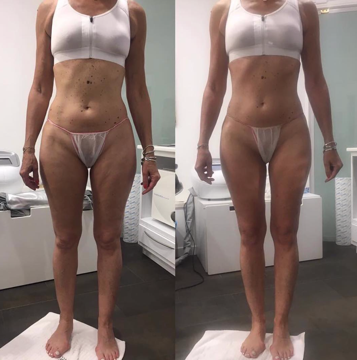 Body Wraps Cellulite