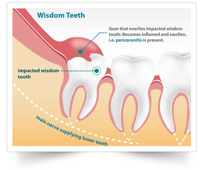 wisdom teeth shelbyville tn